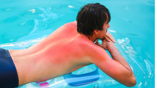 Did You Know? Essential Oils Can Help Treat Sunburn!